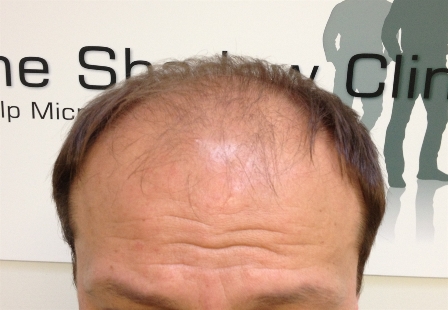 Male_Pattern_Baldness1