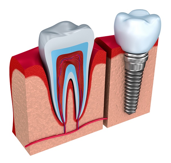 tooth-implant