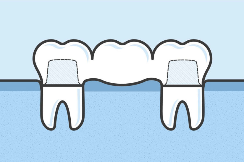 dental-bridges